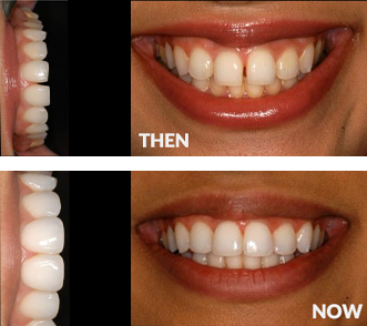 Straightening And Bonding at Start Smiling Dentist in Essex